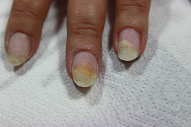 Nail Spots: How ro recognise a Mildew on Nails? | Pics Nails
