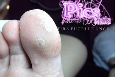 Feet Skin Problems Warts