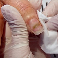 Nail Spots: How ro recognise a Mildew on Nails? | Pics Nails Nail Spots: How ro recognise a Mildew on Nails? | Pics Nails
