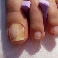 nail fungush eltávolítása nails