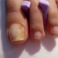 Ingrown Toenail