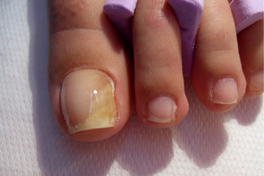 nail fungus onychomicosis nails kezelése