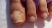 Nail Diseases: how can I solve my Nails Fungus Problem?