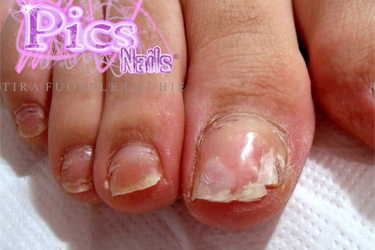 nail fungus3