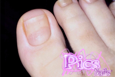 Laser for Fungal Nail Infections - The Foot Clinic