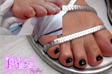 Nails Extension Traumatised Toe Nails Nails Extension Traumatised Toe Nails