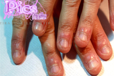 Can I do Nails Extension if I have a Nail Bitting ? | Pics Nails
