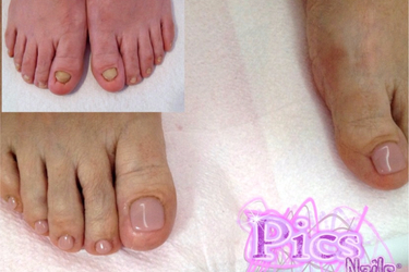 Coverage Nail Extension Foot Tips False Toe Nails Toenail Tablet Toe  NailsTips | eBay