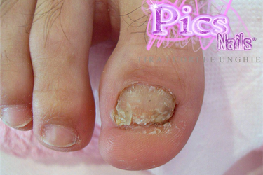 Toe Nails Problems